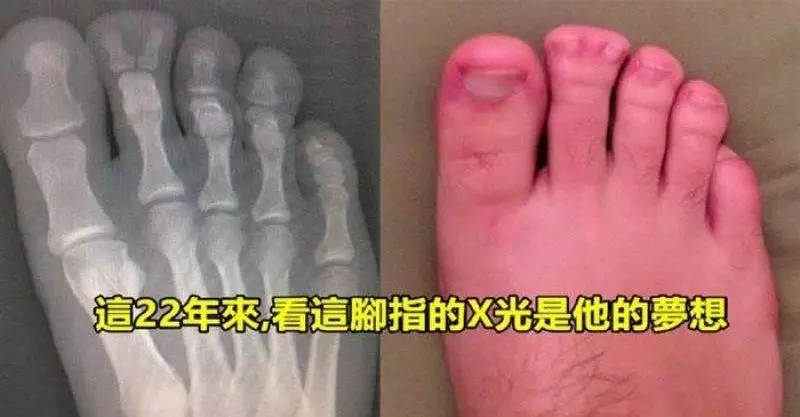 20張用X光顯示肚子裡有異物到底是長怎樣的照片?