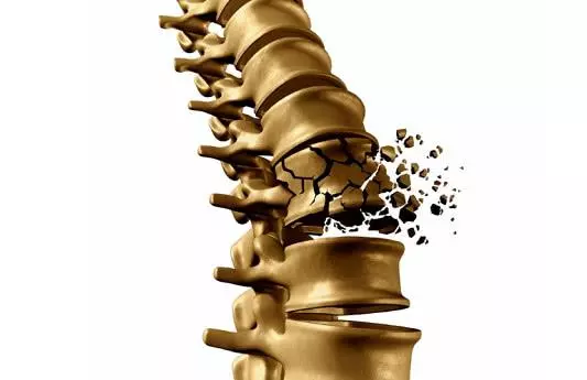 喝骨頭湯能預防骨質疏鬆?專家:防治骨質疏鬆需避開這7大誤區!