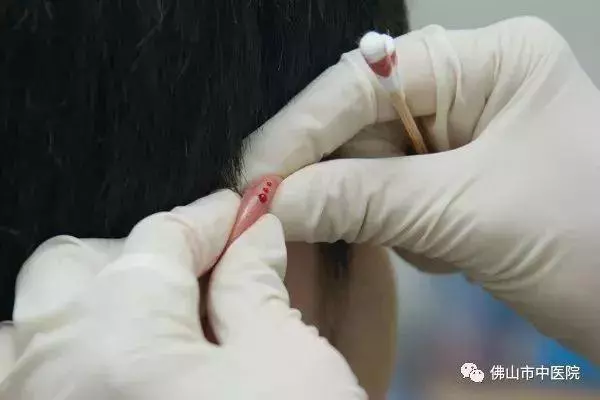 耳朵裡的養生秘密!這5套耳穴操不僅防病還能美容