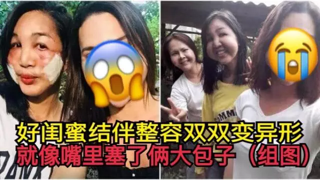 好閨蜜結伴整容雙雙變異形,就像嘴裡塞了倆大包子 !