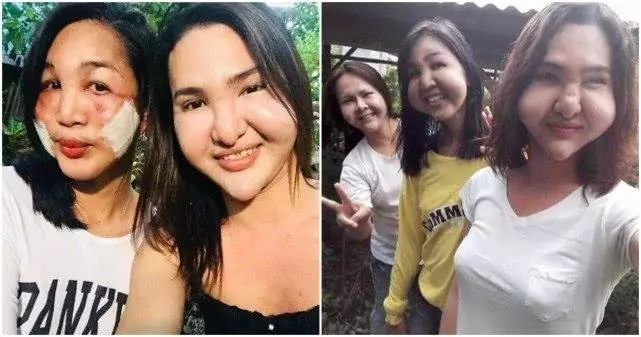 好閨蜜結伴整容雙雙變異形,就像嘴裡塞了倆大包子 !