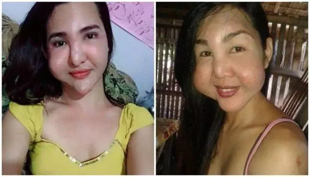 好閨蜜結伴整容雙雙變異形,就像嘴裡塞了倆大包子 !