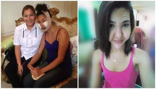 好閨蜜結伴整容雙雙變異形,就像嘴裡塞了倆大包子 !
