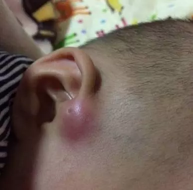 你家寶寶耳朵上有一個小洞嗎?醫生:真相才不是富貴命,家長千萬要重視!!