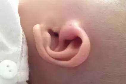 你家寶寶耳朵上有一個小洞嗎?醫生:真相才不是富貴命,家長千萬要重視!!