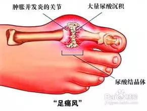 痛風為何從腳起?該怎樣預防和緩解?