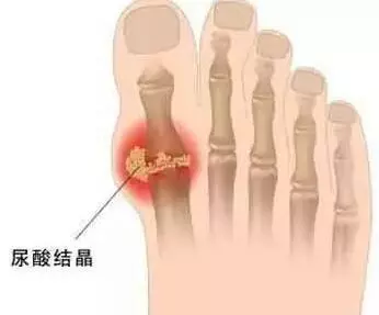 痛風為何從腳起?該怎樣預防和緩解?