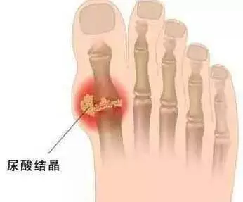 痛風為何從腳起?該怎樣預防和緩解?