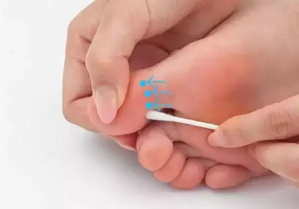 一根棉簽解決身上各種酸痛,立馬感覺無比舒暢!