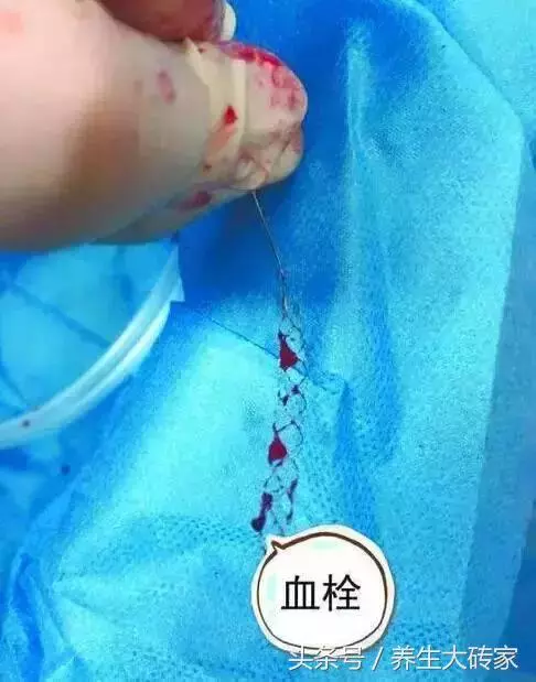 五類人易被血栓「拴住」,一個小動作,「沖洗」血管,遠離血栓!