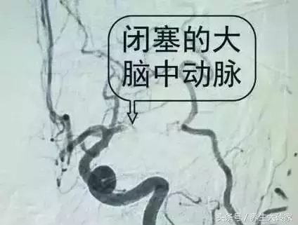五類人易被血栓「拴住」,一個小動作,「沖洗」血管,遠離血栓!