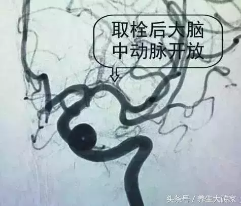 五類人易被血栓「拴住」,一個小動作,「沖洗」血管,遠離血栓!