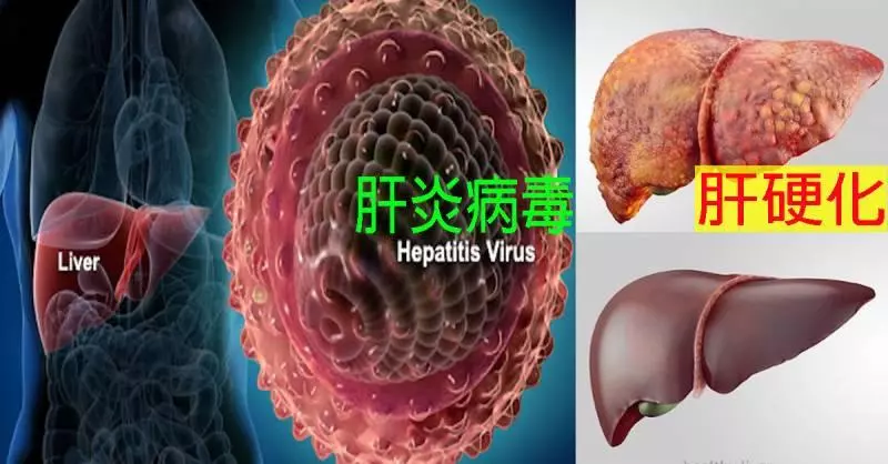 七成民眾肝病不自知,兩年內死亡率高達300%!一秒自測「12種早期徵兆」莫輕忽!!