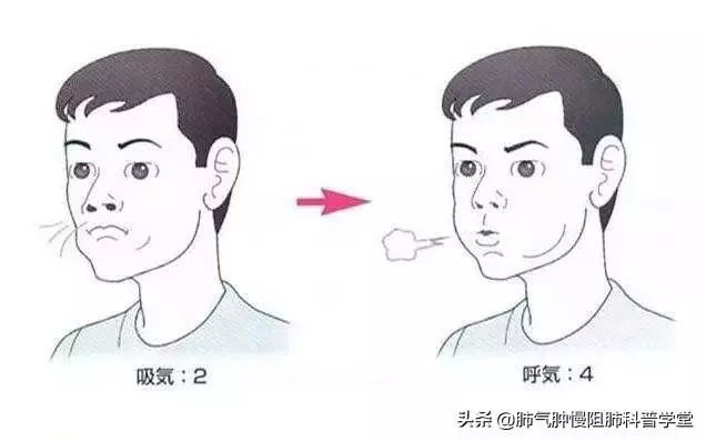 慢支、慢阻肺每日需做呼吸鍛煉,呼吸鍛煉方法有哪些有何好處?