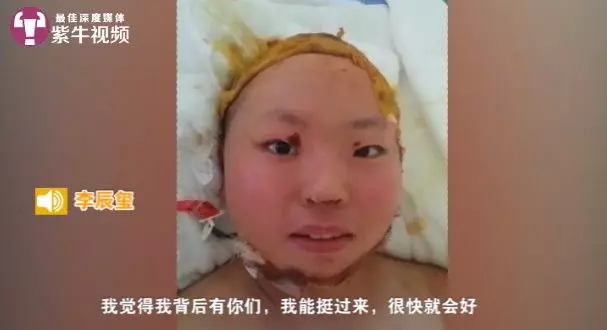 別告訴她!17歲愛女被火燒80%灼傷「爸爸都沒去醫院看她」…事實讓網友爆哭