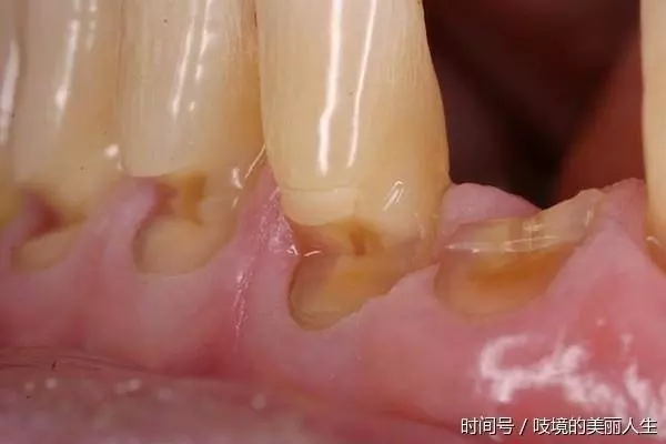 牙齦一旦萎縮,就容易「塞牙」、「牙根酸痛」,這方法可以幫到你,很直接哦!