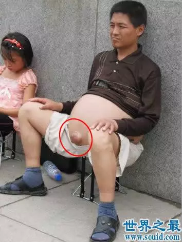 奇聞異事!世界上最恐怖的50種怪病,肚子竟然上長了...!!(多圖)
