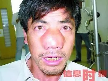奇聞異事!世界上最恐怖的50種怪病,肚子竟然上長了...!!(多圖)