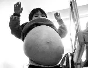 奇聞異事!世界上最恐怖的50種怪病,肚子竟然上長了...!!(多圖)