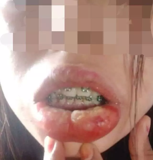 女子愛美的代價太慘痛!花190令吉綁牙結果讓自己受苦