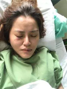 【喪盡天良 · 撞人逃跑!】大馬女網紅遭無良司機撞後逃跑,最終破相又斷腿!網紅:「希經過爆出...