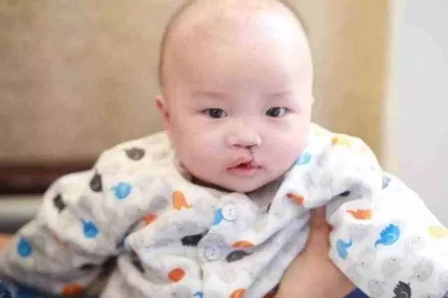 產檢胎兒是兔唇,媽媽堅持把他生下,幾個月後孩子變化令人驚喜