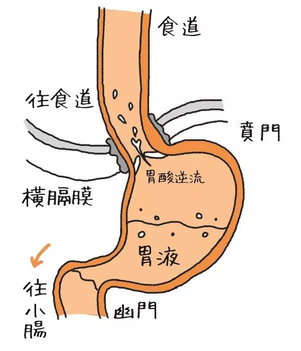 胃食道逆流光吃藥不會好!除了甜食、油炸,營養師:這5種食物也要少吃