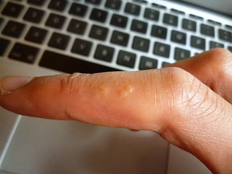 手上的「小水泡」越抓越癢,只要跟著做,既能痊癒,又不抓破皮。真的很實用!