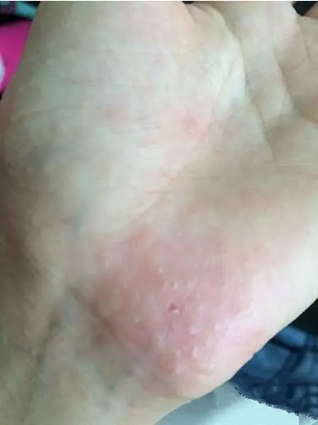 手上的「小水泡」越抓越癢,只要跟著做,既能痊癒,又不抓破皮。真的很實用!