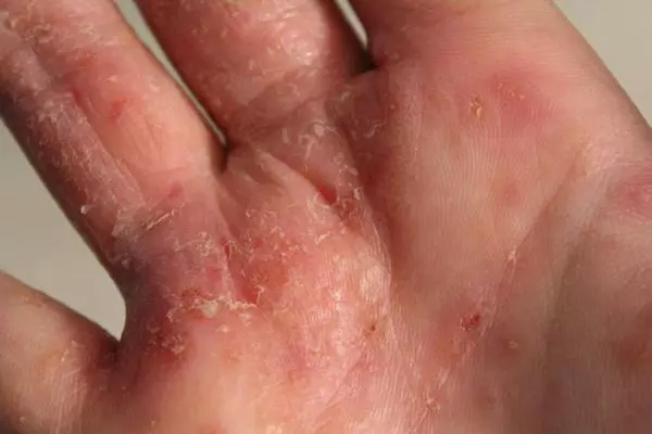 手上的「小水泡」越抓越癢,只要跟著做,既能痊癒,又不抓破皮。真的很實用!