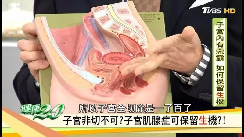 子宮肌瘤是「吃」出來疾病,4種食物能不碰就不碰, 女人為自己收藏...