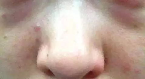 晚上睡不著,易失眠,口幹口苦,警惕肝火過旺,3個小方法降肝火,肝越來越好...