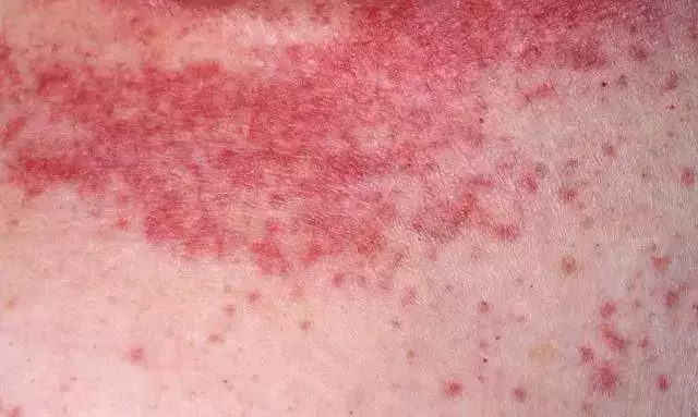 皮膚瘙癢難耐?綠豆加百合一起煮,每天早晚各一次,皮膚不癢了,濕疹躲著跑