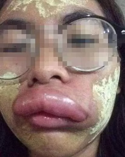 泰國女孩嫁中國小夥,新婚激戰後....第二天變「香腸嘴」,醫生的話讓他們很尷尬