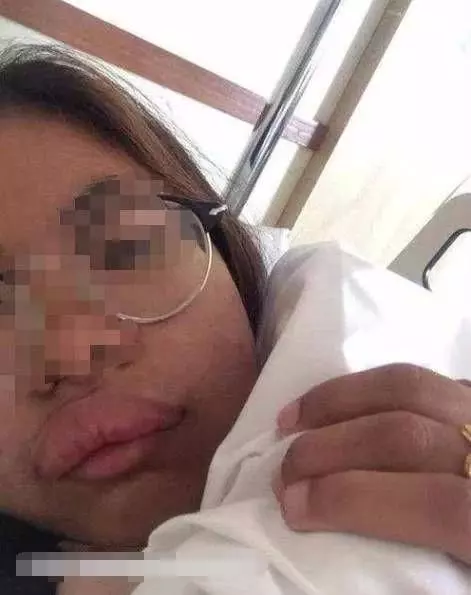 泰國女孩嫁中國小夥,新婚激戰後....第二天變「香腸嘴」,醫生的話讓他們很尷尬