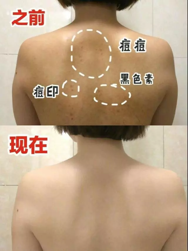 後背痘痘老是消不了!原來是體濕太重了,教你三招簡單祛濕!