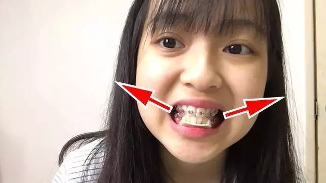 私人vs政府 · 誰更好?大馬美女分享了她在「政府醫院」綁牙的過程 原來政府和私人的待遇是那麼大差別的啊?