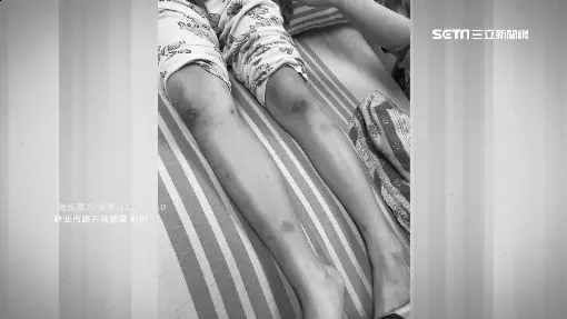 疑遭虐死亡…11歲女童身體不明色塊 生母喊冤:那是胎記 【內附視頻】