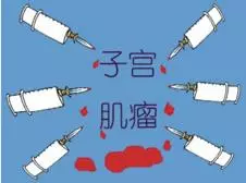 40-50歲婦女中有一半人患有子宮肌瘤,除了開刀,沒別的辦法嗎?