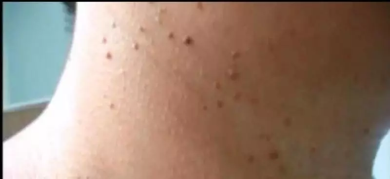 只需1周,就能讓脖子上的「肉粒」徹底脫落!永遠不再長出來!