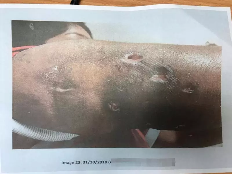 觸目驚心! 手臂瘦不成 留下千瘡百孔 | 中國報 China Press