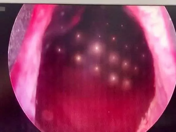 70顆磁珠塞進下體 11歲男童:尿尿特別痛