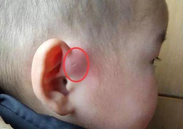 孩子生下來耳朵上就有小孔?不是福氣,爸媽要心裡有數,不容忽視