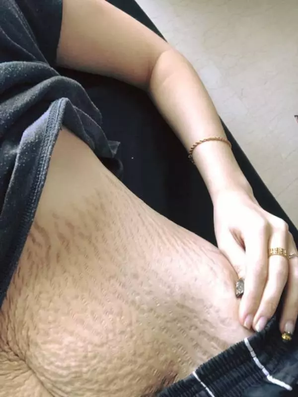 【請好好珍惜為你生孩子的女生】大馬正妹生完四胞胎後 見自己的肚子直接飆淚!!