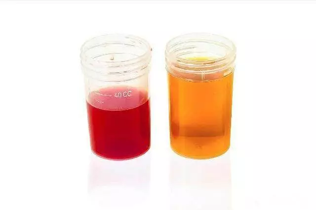 高尿酸「吃」出來,醫生提醒:6種食物不要吃,幫你遠離腎衰竭!