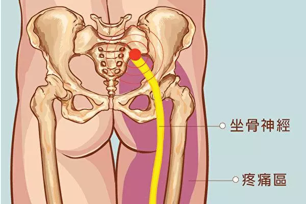 預防坐骨神經痛中醫師教按摩三穴道