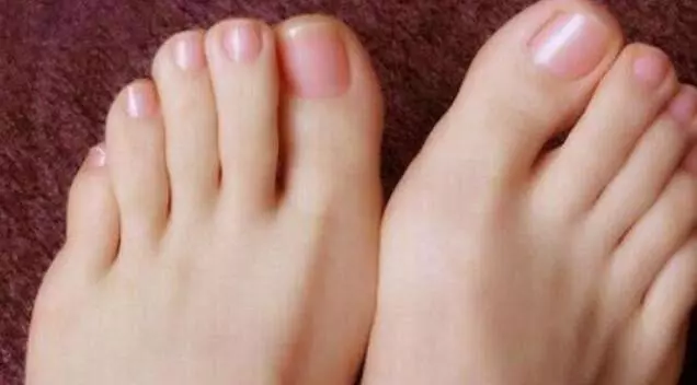 如果「腳趾」有這個, 說明癌細胞盯上你了, 千萬注意!最好去醫院做檢查! !