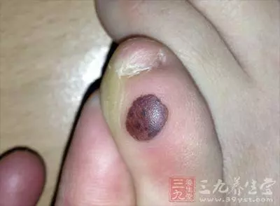 如果「腳趾」有這個, 說明癌細胞盯上你了, 千萬注意!最好去醫院做檢查! !