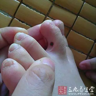 如果「腳趾」有這個, 說明癌細胞盯上你了, 千萬注意!最好去醫院做檢查! !