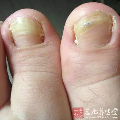 如果「腳趾」有這個, 說明癌細胞盯上你了, 千萬注意!最好去醫院做檢查! !